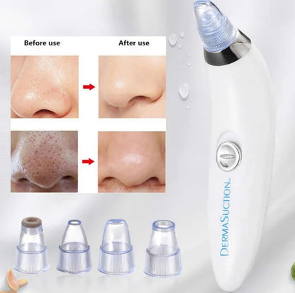 DermaSuction Pro – Deep Pore Blackhead Remover (Original)