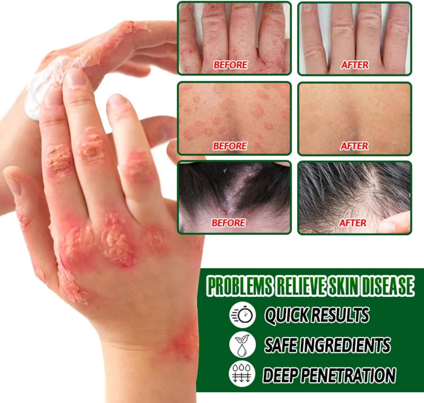 Psoriasis Cream (Original) – 20g Each (Pack of 2)