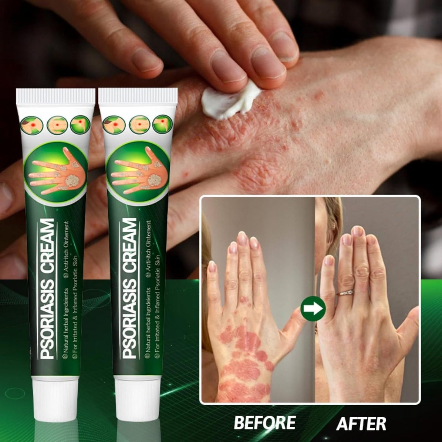 Psoriasis Cream (Original) – 20g Each (Pack of 2)
