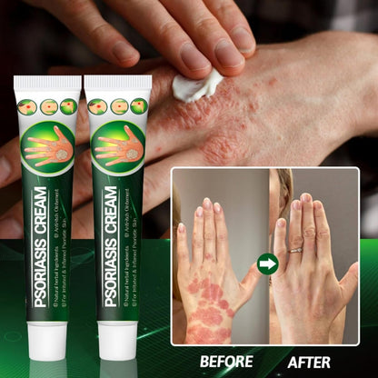 Psoriasis Cream (Original) – 20g Each (Pack of 2)