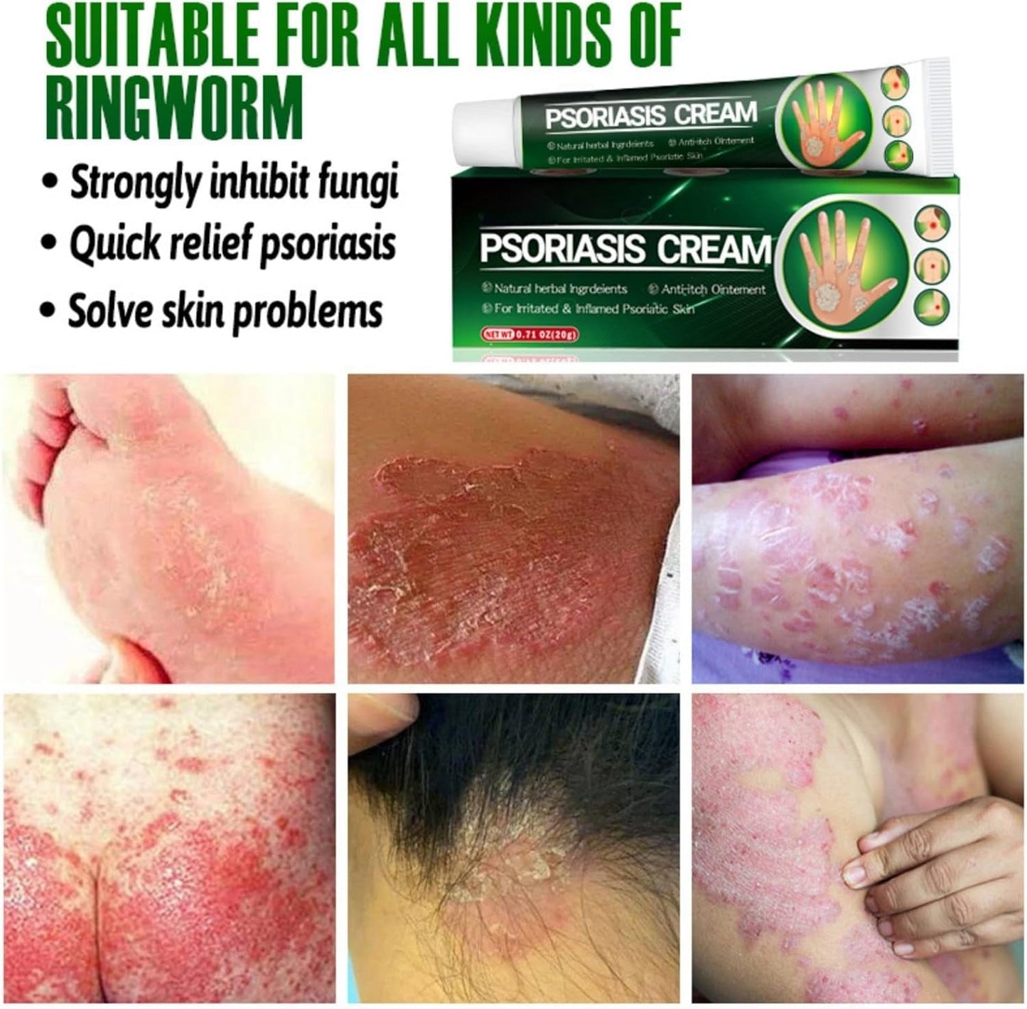 Psoriasis Cream (Original) – 20g Each (Pack of 2)