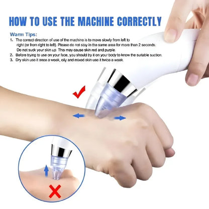 DermaSuction Pro – Deep Pore Blackhead Remover (Original)