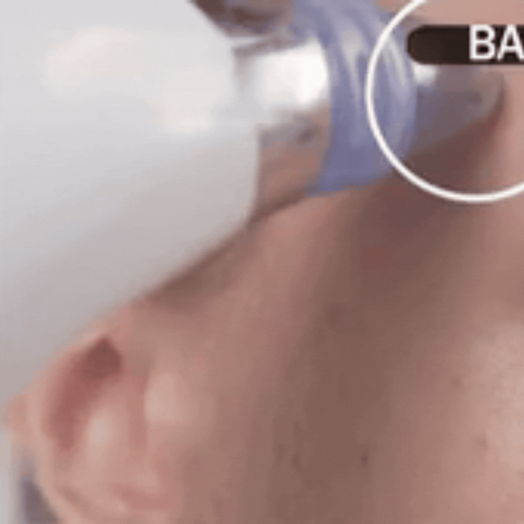 DermaSuction Pro – Deep Pore Blackhead Remover (Original)