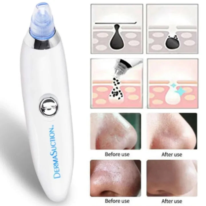DermaSuction Pro – Deep Pore Blackhead Remover (Original)