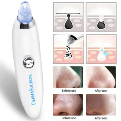 DermaSuction Pro – Deep Pore Blackhead Remover (Original)